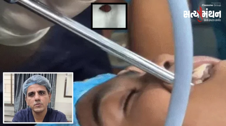 વડોદરામાં 8 વર્ષના બાળકની શ્વાસનળીમાંથી 6 મહિના બાદ બોરનો ઠળિયો બહાર કાઢાયો, તબીબોની ચેતવણી
